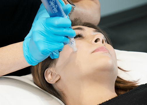 A woman undergoing a SkinPen treatment